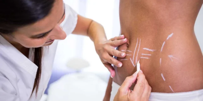 Mons Pubis Liposuction & Reduction by Dr. Amulya Gumpalli in Madhapur, Hyderabad – Expert Cosmetic Gynecology Care